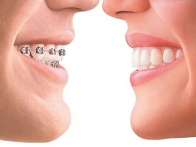 La soluzione: l’ortodonzia